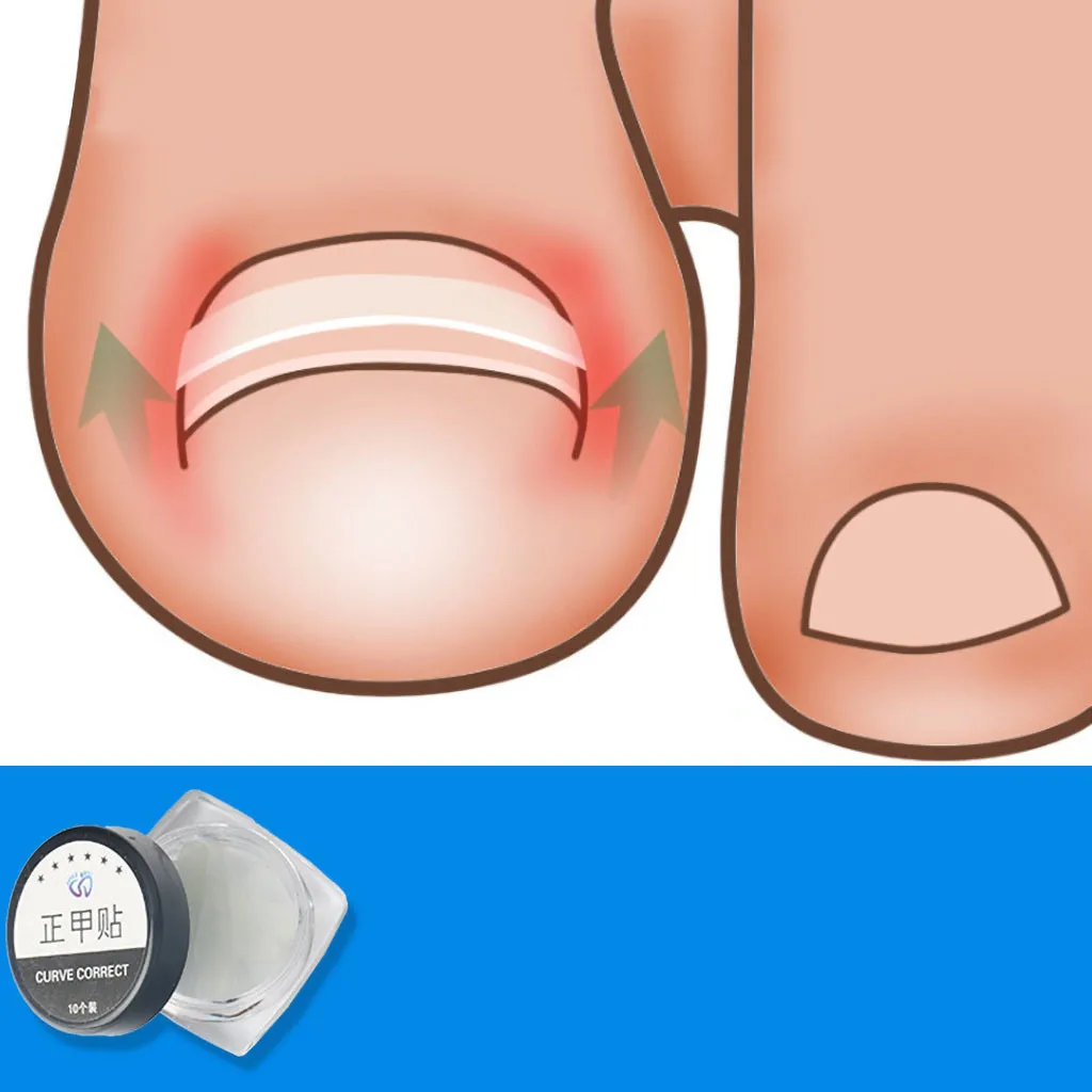 10 шт. ортодонтический Toenail патч для ухода за ногами Paronychia лечение педикюр инструменты ингредиент фиксация силы Уход за ногами пилка для ног