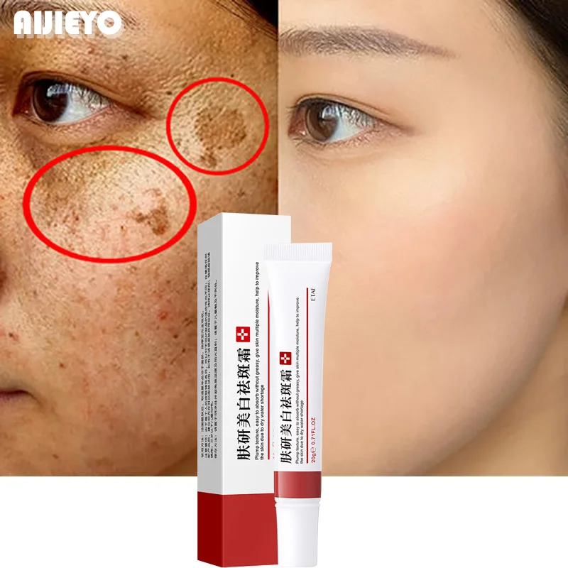 Whitening-Freckle-Cream-Remove-Melasma-Cream-Remove-Dark-Spots-Melanin ...