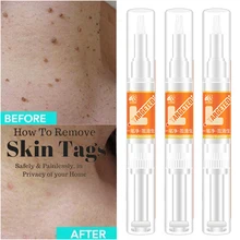 Машинка для удаления магнитных бирок кожи бирки моль ноги кукурузы бородавок Лечение Уход за кожей Инструмент давление ног патч удаление 5 мл