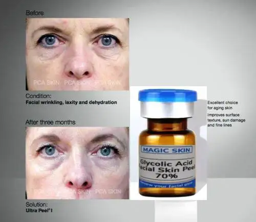 Buccia Chimica Acida Per Il Viso, Neutralizzatore Esfoliante, Pennello. Pelle Normale. Cura Della Pelle