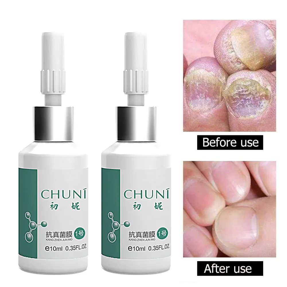 

20ml Accelerate Growth Antifungal Peeling Portable Harden Leuconychia Restore Nail Repair Glue Ringworm Relustering External Use