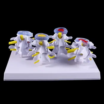 

1 Set Human Lumbar Lesion Spine Statue Display Model Medical Teaching Learning Tool