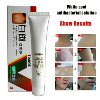 

White Spot Antibacterial Cream Chinese Medical Pigment Vitiligo Leukoplakia Disease Treatment Melanin Promoting Skin Health Care