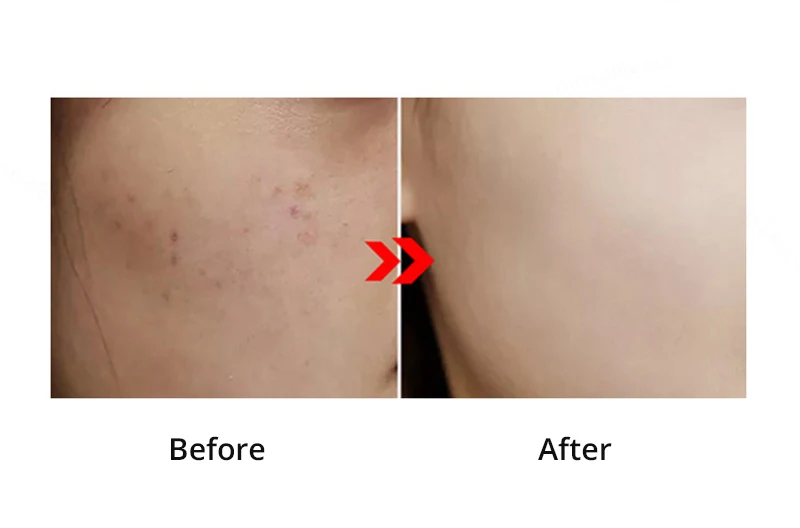Плазменный массажер для лица, отбеливание, удаление акне, стерилизация кожи, глубокое очищение, RF Устройство ЭМС, лифтинг для лица, плазменная машина для красоты