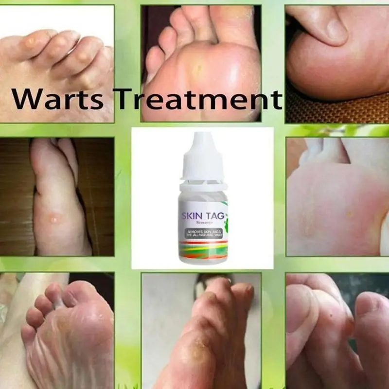 3types Wart Cream Skin Tags Mole Calluses Foot Corn Removal Ointment