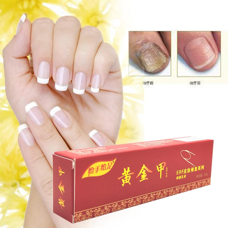 Китайская травяная мазь для лечения грибка ногтей|fungus treatment|nail fungus treatmentnail treatment |
