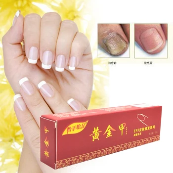 

Nail Fungus Treatment / Onychomycosis Paronychia / Anti Fungal Nail Infection Good Result Chinese Herbal Toe Nail Treatment