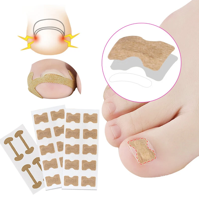 

Ingrown Toe Nail Correction Patch Paronychia Corrector Sticker Pedicure Orthodontic Toe Thumb Patch Stickers Pain Relief Toenail