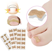 Remendo encravado da correção do prego do dedo do pé adesivo corrector paronychia pedicure ortodontic toe polegar remendo adesivos alívio da dor