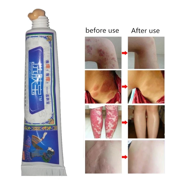 Skin Care Herbal Body Cream Psoriasis Cream Dermatitis Itching Repair Eczematoid Ointment Treatment Psoriasis 1