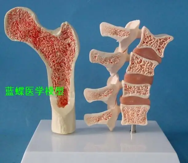 A comparative model of osteoporosis and morbidity in human body bone skeleton femoral plane medical display model A comparative model of osteoporosis and morbidity in human body bone skeleton femoral plane medical display model