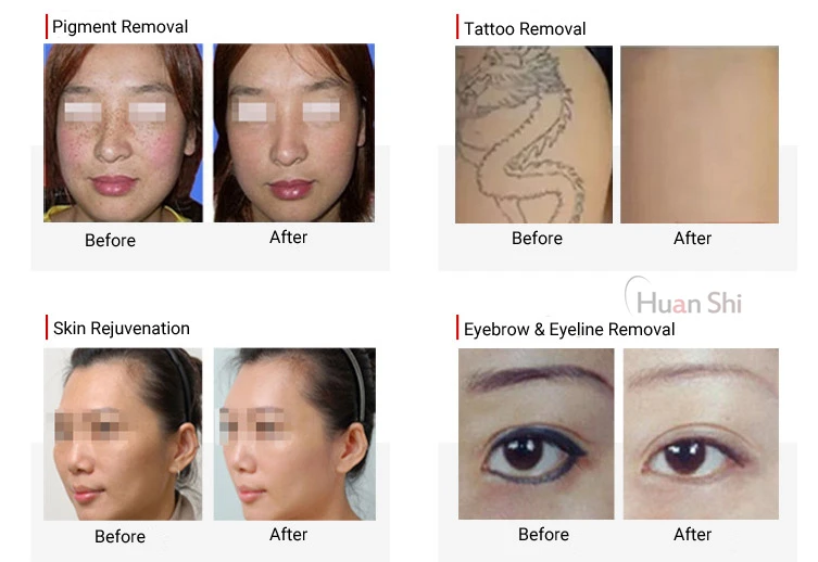 Best Pico Laser Portable Nd:Yag Laser 755/1320/1064/532nm Picosecond Laser Beauty Machine For Tattoo Removal