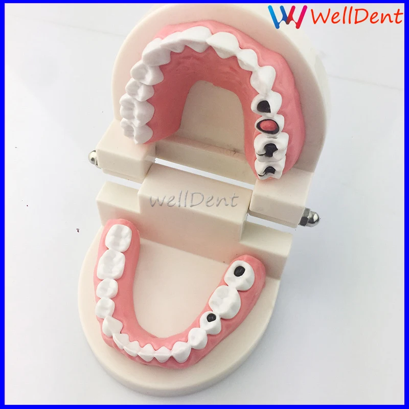 1x-EASYINSMILE-Dental-Caries-Tooth-Study-Model-Typodont-_57