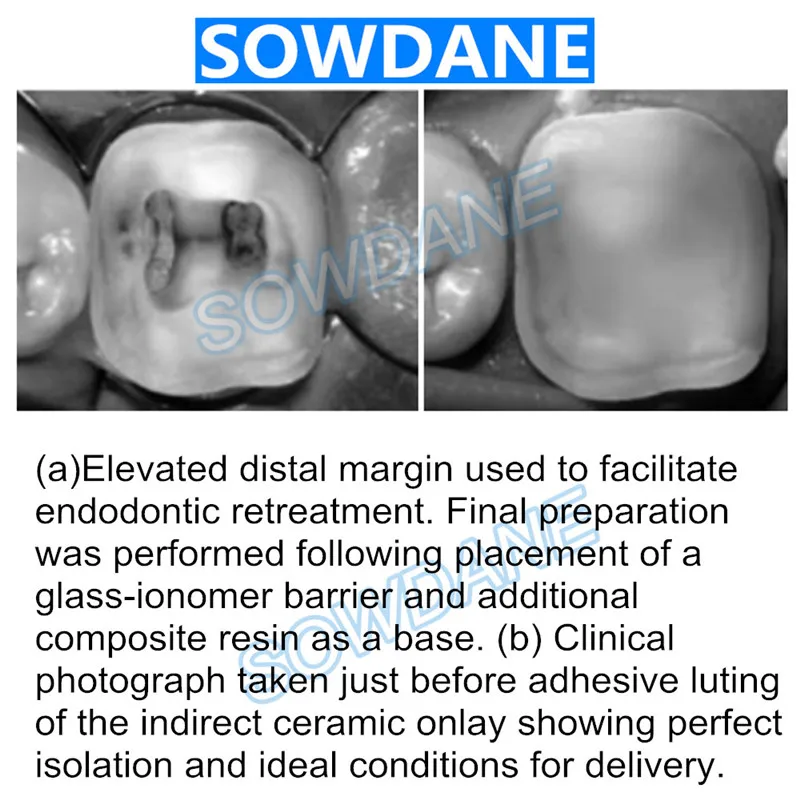 Dental-Tofflemire-Matrix-for-Deep-Margin-Elevation-Large-Curvature-Matrices-Retainer-Sectional-Contoured-Matrice-dental-Material (1)