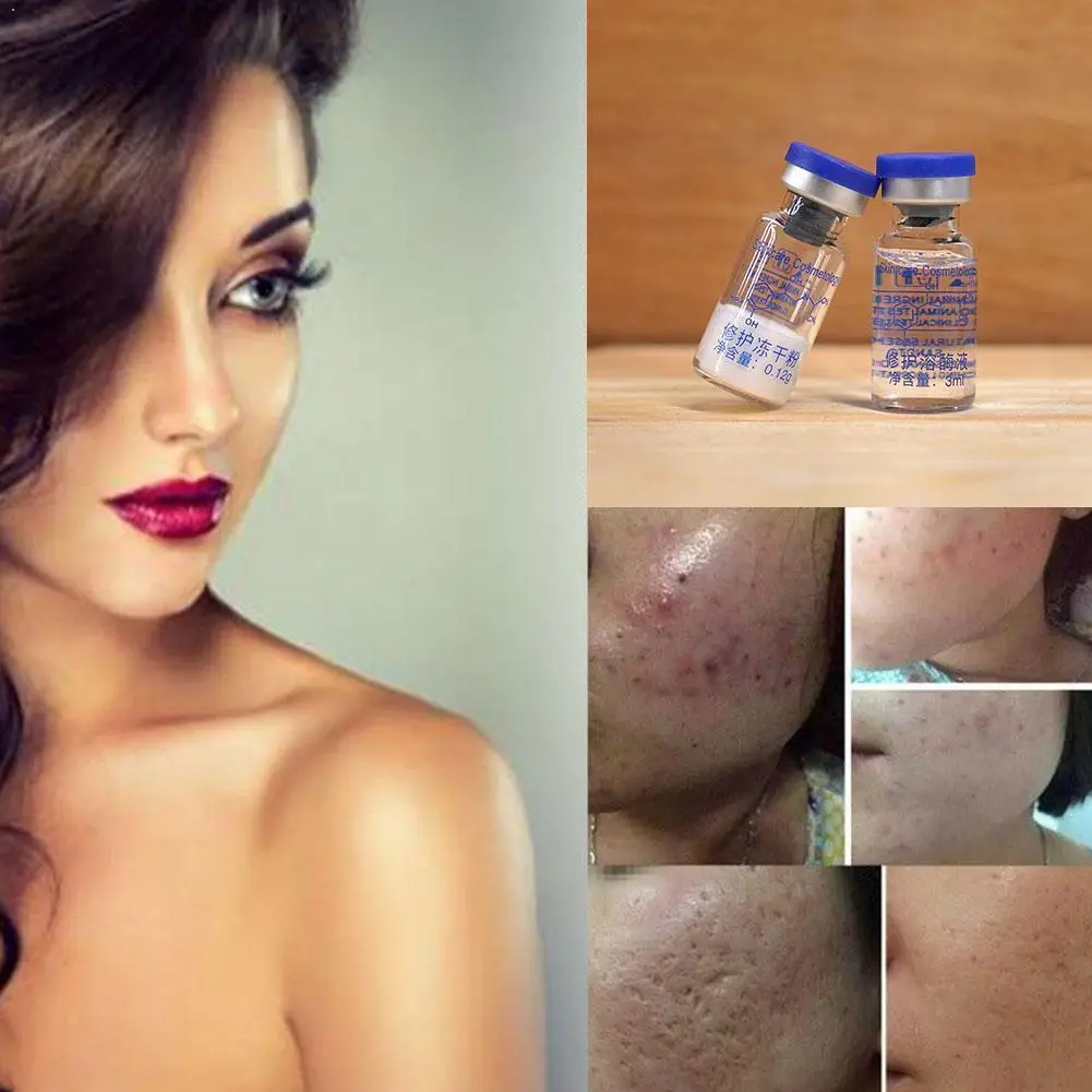 

Oligopeptide Freeze-dried Mask Epidermal Growth Factor Acne Powder Wrinkles Care Serum Pimples Skin Treatment Scars K2M0