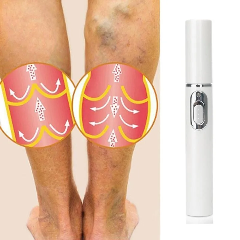 Blue Light Therapy Varicose Vein Pen Medical Varicose Scar Vein Pen Light Blue Acne Therapy Treatment P0R3 3