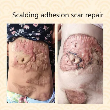 

Remove scars repair solution, burn /scald adhesions scar repair, damage, itching, eliminate scars