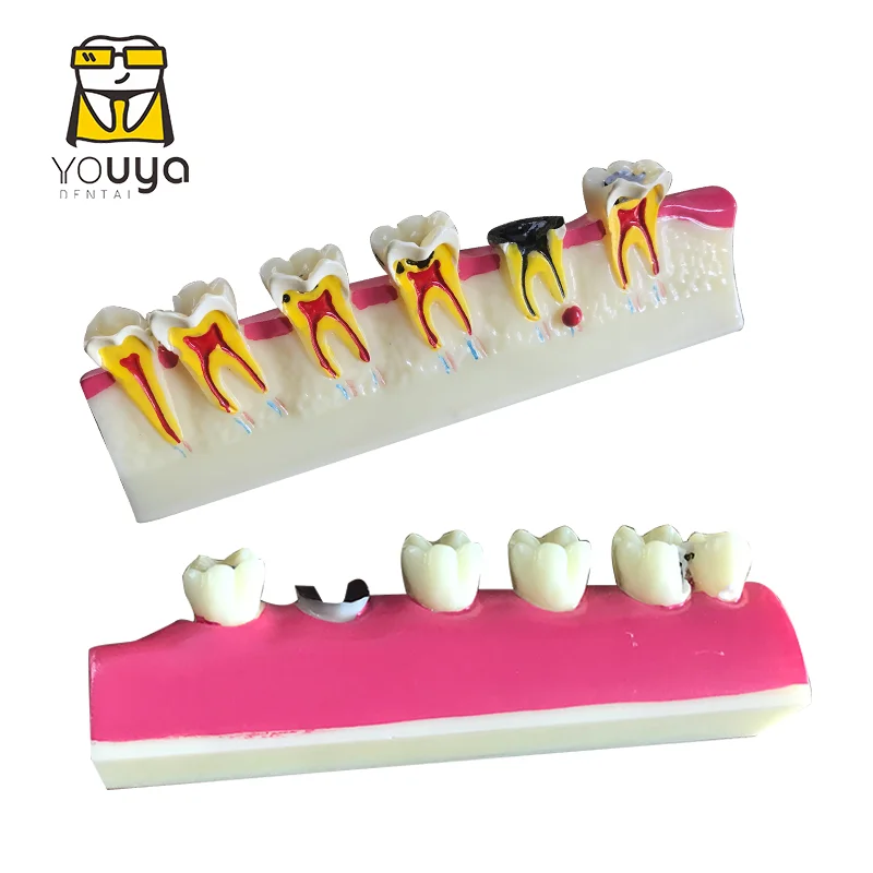 

Model Of Periodontal Decay Progression Dental Teaching Demonstrationã€Doctor-Patient Communication Model Studying Dental Diseases
