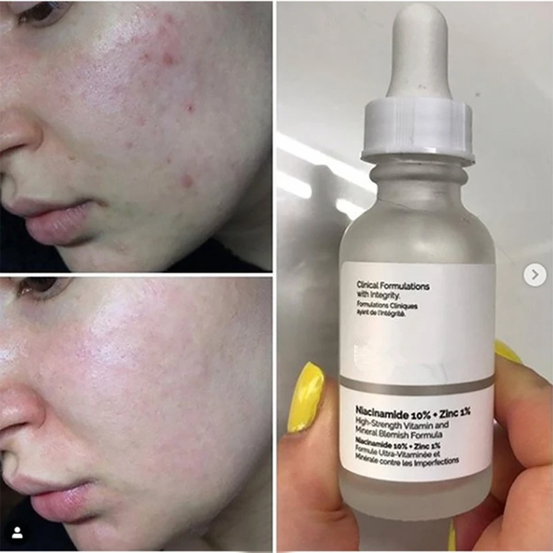 Niacinamida 10% + zinco 1% comum 30ml alta essência mineral regula sebo e minimiza os poros maquiagem primer soros faciais