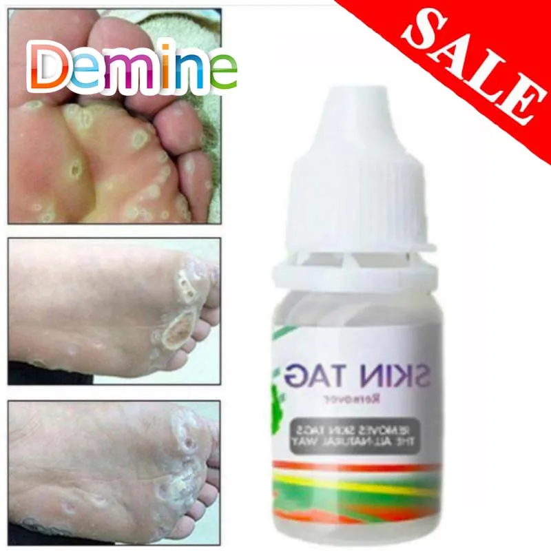 

Body Warts Treatment Wart Cream Skin Tag Remover Foot Corn Removal Plantar Genital Warts Ointment Shoe Accessories Dropshopping