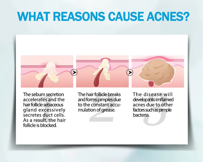 anti-acne_06