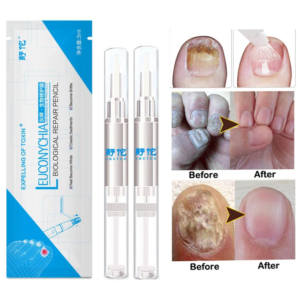 

2PCS Effectively Eliminate Nail Fungus Pen 3ml Onychomycosis Paronychia Herbal Toe Finger Nails Infection Medicinal TSLM1