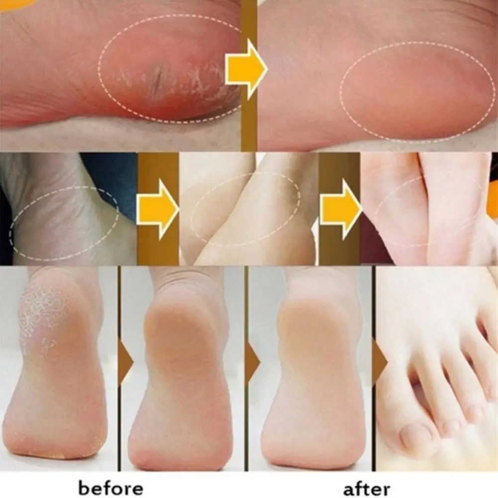 Hand And Foot Repair Cream Heel Crack Blisters Anti chapping Peeling
