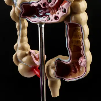 

Human Colorectal Lesion Model Pathological Anatomy Colon Diseases Intestine Teaching Learning Tool H55F