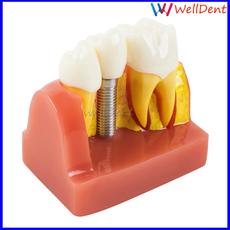 Dental-Implant-Teeth-Model-Analysis-Crown-Bridge-Demonstration-_57 (1)