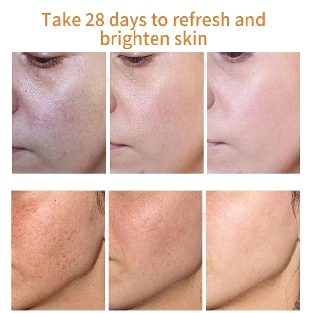 iBeaLee Whitening Freckle Cream Remove Melasma Cream Remove Dark Spots Melanin Melasma Remover Brighten Skin Anti-Aging 2