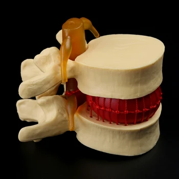 

Anatomical Spine Lumbar Disc Herniation Anatomy Teaching Tool 090F