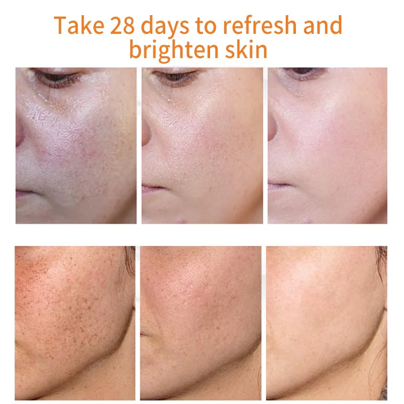 VOVA Dark Spot Remover Freckle Cream Remove Melasma Acne Spot Pigment Melanin Bleaching Dark Spots Pigmentation Whiten Skin Care