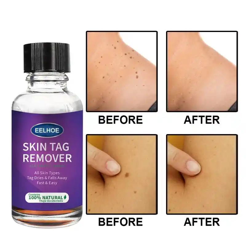 mole and skin tag remover