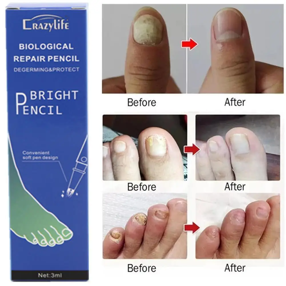 

1pc Treatment Pen Foot Fungus Anti Fungal Nail Chinese Care Treatment Oil Liquid Medicinal Repair Nail Nail 3ml Herbal Cuti Q8V2