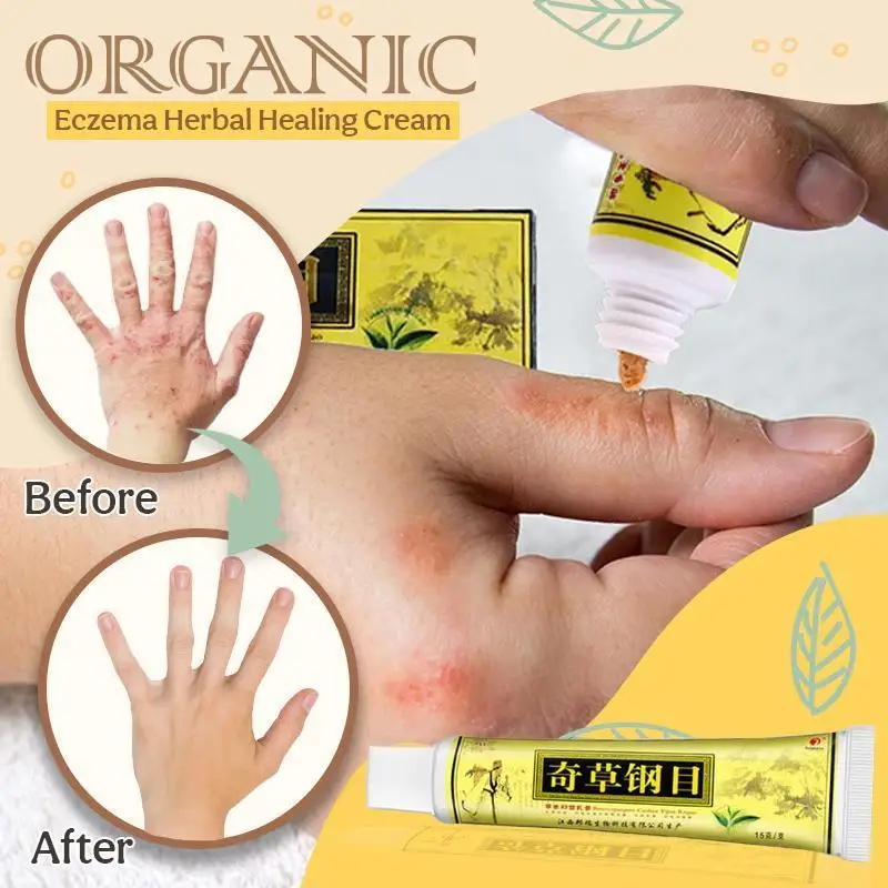 Organic Eczema Herbal Healing Cream Perfect For Dermatitis and Pruritus Psoriasis Ointment Creams | Красота и здоровье