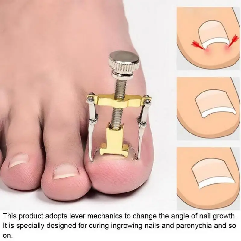 Metal Orthopedic Supplies Ingrown Toe Nail Recover Tool Foot Nail Corrector Toenail Fixer Pedicure Care Bunion Nail Pedicur U8J5