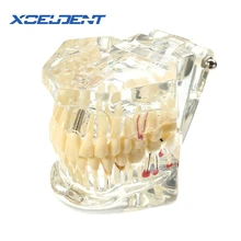 1 шт. зубной имплантат, зубная модель с реставрационным мостом, зубной Стоматолог для медицинской медицины, стоматологический тест на лечение