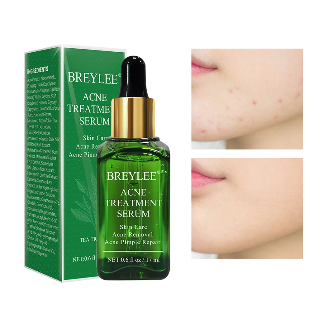 BREYLEE 17ml Acne Treatment Face Serum Mask Anti Acne Pimple Scar Remover Moisturizing Whitening Skin Care Facial Essence Cream 