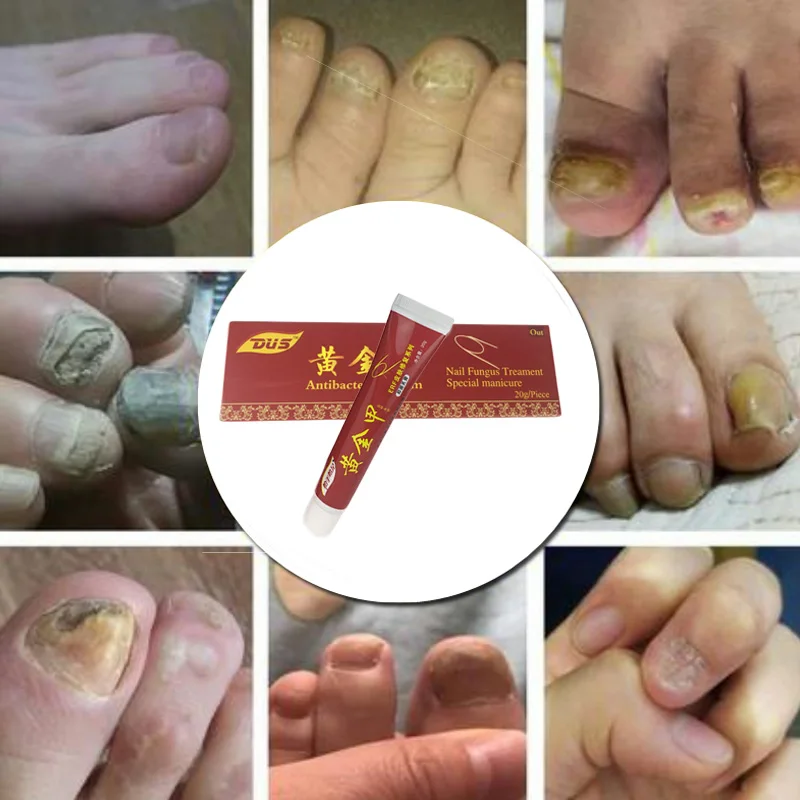 Лечение ногтей onychomicosis Paronychia анти грибковая инфекция ногтей хороший результат Китайский Травяной Уход за ногтями
