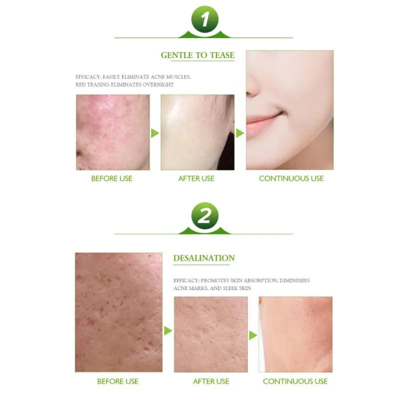 Aichun beauty, очищающий крем для лица от акне, уход за кожей, удаление комедона, прыщей, средство для снятия крема, лечение акне