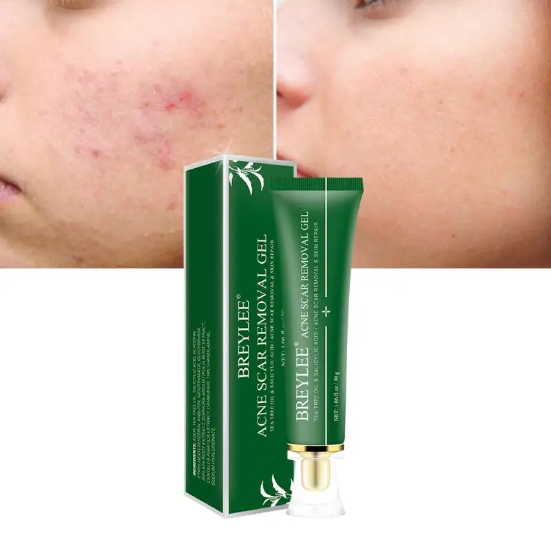 pigmentation & acne scar removal cream