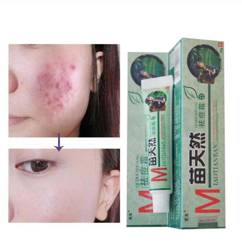 

1 Pc Moisturizeing Skin Cream Original Remove Acne Cream Germicidal Remove Mite You Really Deserve It