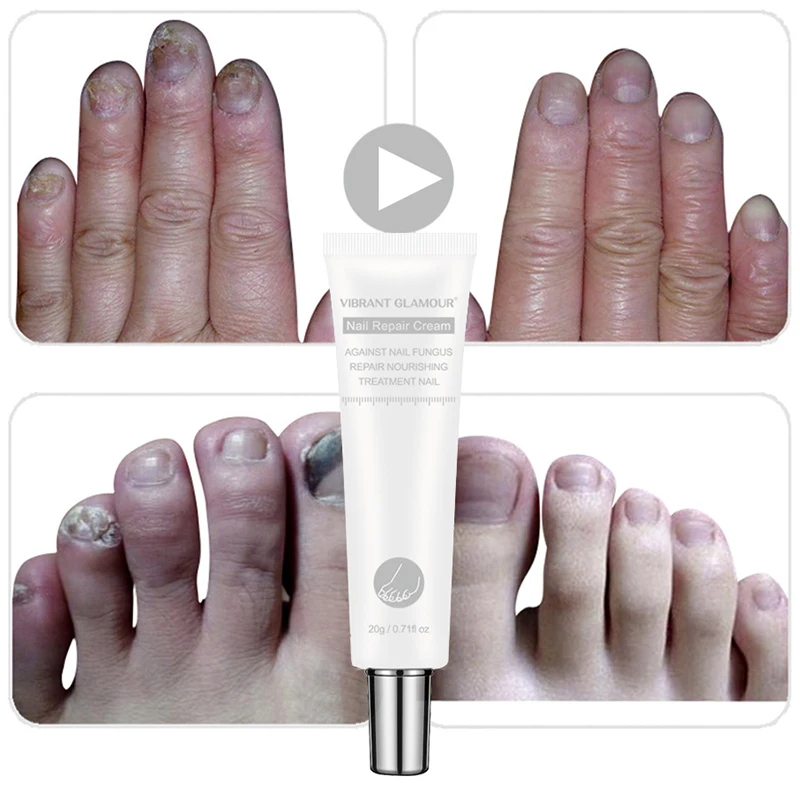 Крем для ухода за ногтями VIBRANT Glamur, 20 мл, для восстановления ногтей, Лечение грибка, удаление онихомикоза, против грибок ногтей, крем для восстановления пальцев ног