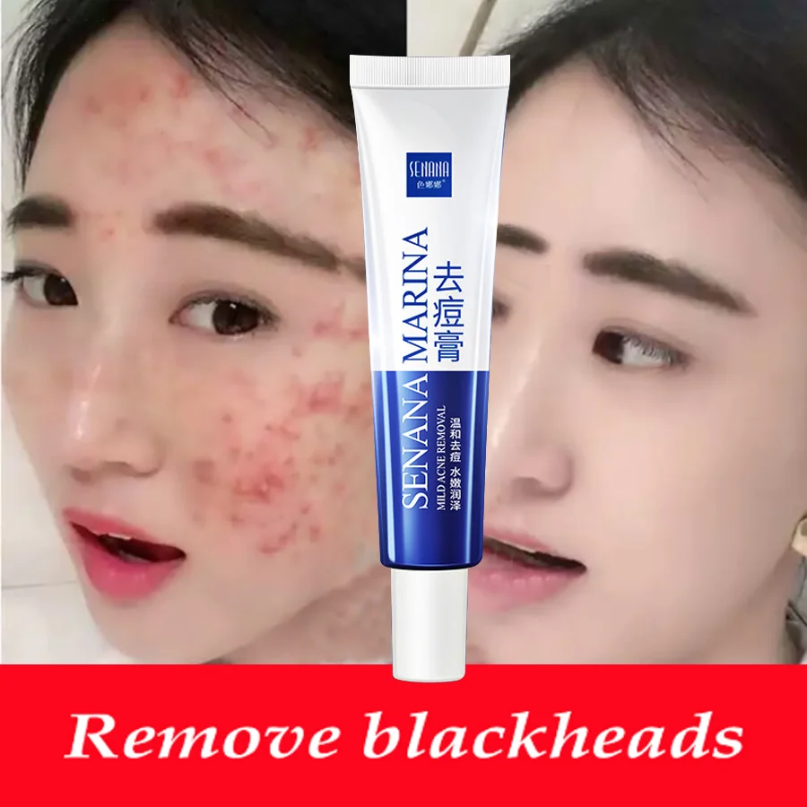 LAIKOU Acne Treatment Gel Blackhead Remove Face Cream Shrink Pores Scar Anti Whitening Skin Care |