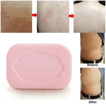 

Sulphur Soap Antibacterial Soaps For Acne Psoriasis Eczema Clearance Skin Repair