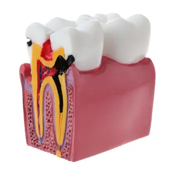 

6 Times Dental Caries Comparation Anatomy Teeth Model for Dental Anatomy Lab Teaching Studying Researching Tool
