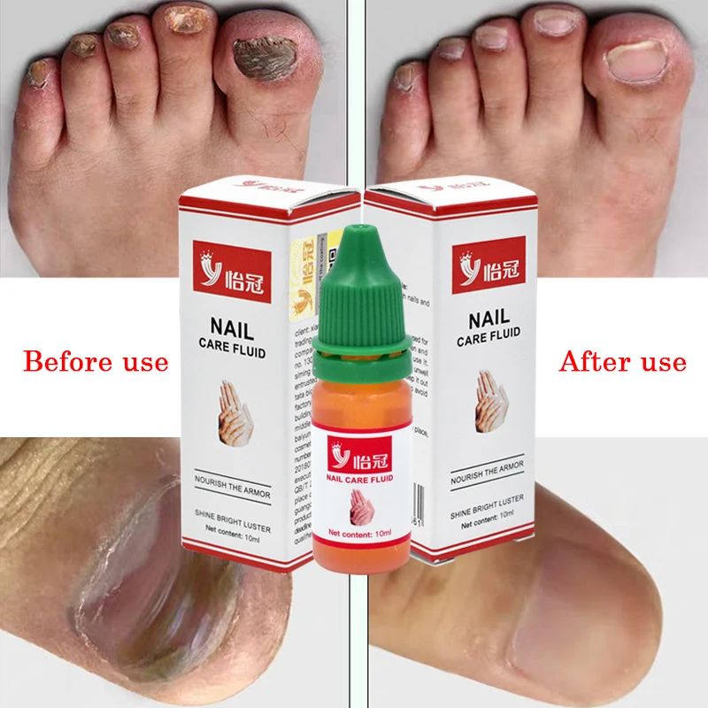 Травяной грибковый гель для удаления грибка ногтей на ногах Уход за ногами эссенция для отбеливания ног яркий анти-инфекционный дропшиппинг