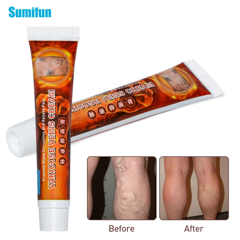 

Sumifun 2020 New Varicose Veins Treatment Cream 100% Original Vasculitis Phlebitis Spider Pain Relief Ointment Medical Plaster