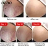 Pregnancy Scars Remove Stretch Marks Cream Treatment Maternity Repair Anti-Aging Anti-Wrinkles Firming Stretch Mark Body Creams ► Photo 2/6