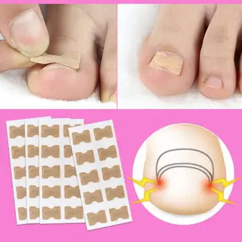 

1/5pc Ingrown Toenail Correction Tool Ingrown Toe Nail Treatment Elastic Patch Sticker Straightening Clip Brace Pedicure Tool